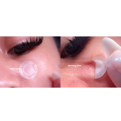Microdart Acne Pimple Patch Kit