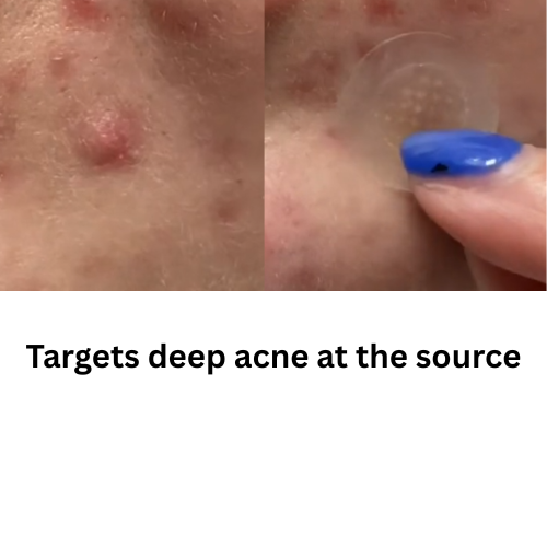 Microdart Acne Pimple Patch Kit